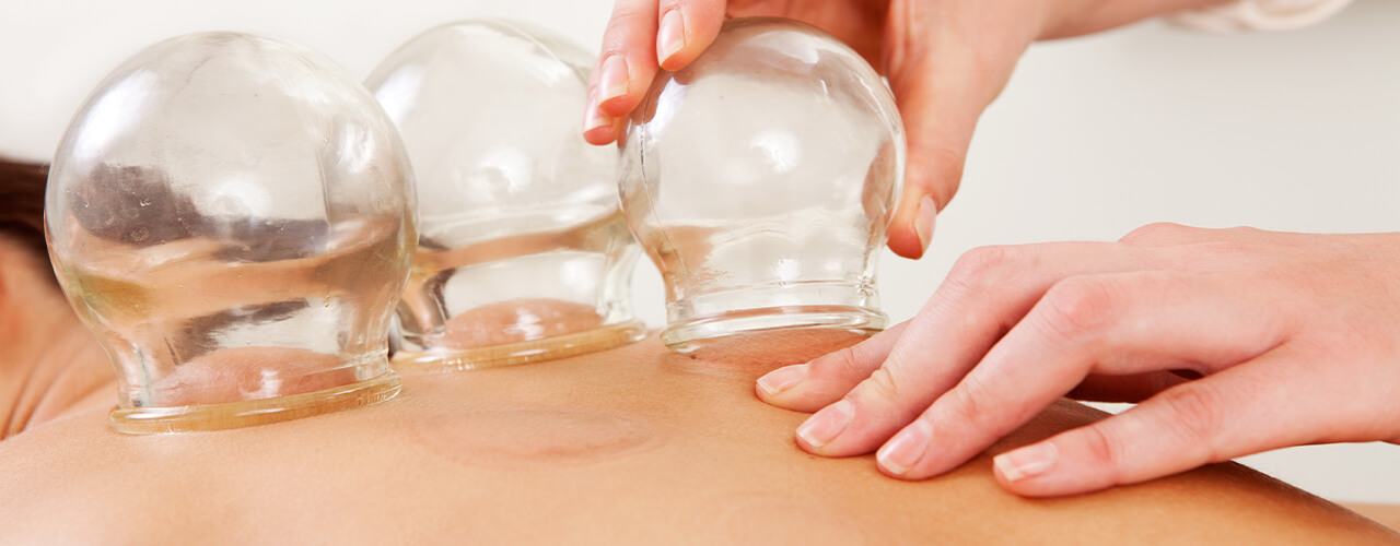 cupping