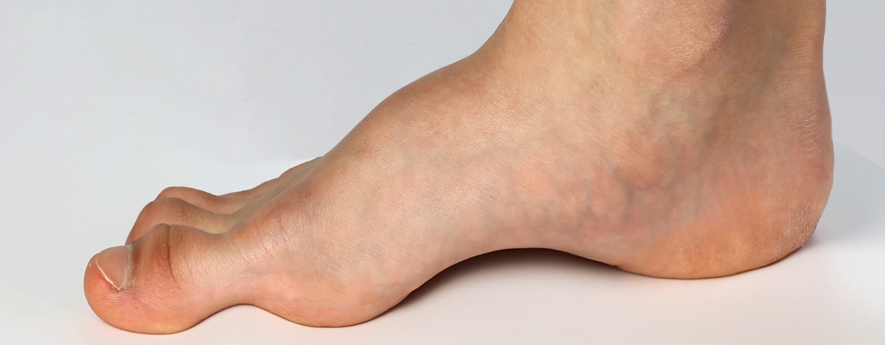 Charcot-Marie-Tooth-Peninsula-Physical-Therapy-And-Aquatic-Rehabilitation-Hampton-VA