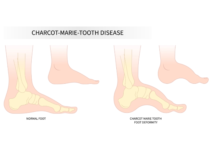 Charcot-marie-tooth-disease-Peninsula-Physical-Therapy-And-Aquatic-Rehabilitation-Hampton-VA