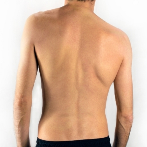 Scoliosis-Peninsula-Physical-Therapy-And-Aquatic-Rehabilitation-Hampton-VA