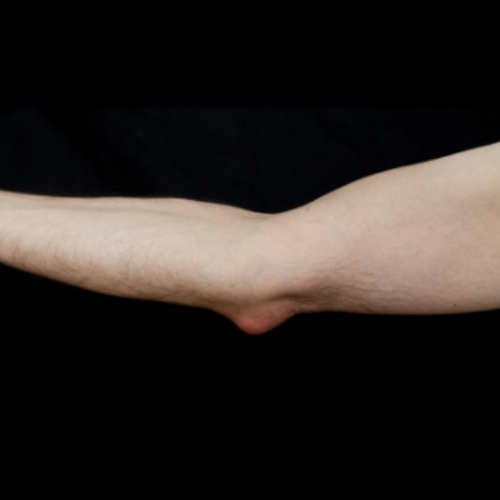 bursitis-Peninsula-Physical-Therapy-And-Aquatic-Rehabilitation-Hampton-VA