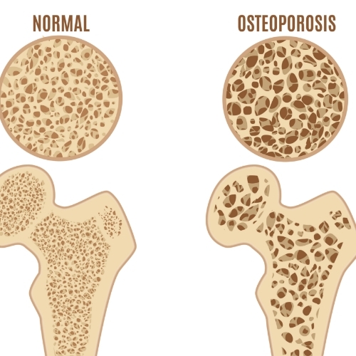 osteoporosis-Peninsula-Physical-Therapy-And-Aquatic-Rehabilitation-Hampton-VA